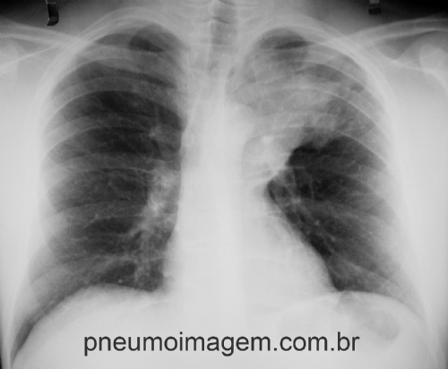 UM EM CADA 4 ADULTOS N�O RESPONDE AO TRATAMENTO AMBULATORIAL DA PNEUMONIA